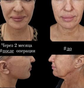 СМАС лифтинг, платизмопластика. 3 месяца после операции
