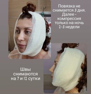СМАС лифтинг, платизмопластика. Так выглядят пациенты на 2-е сутки после операции