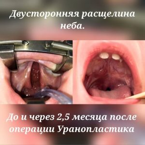 Двусторонняя расщелина нёба. 3 месяца после операции уранопластика