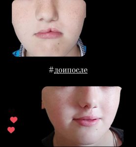 Коррекционная хейлопластика. У ребенка врожденная левосторонняя расщелина верхней губы. В младенчестве выполнена первичная хейлопластика.