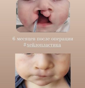 Двусторонняя расщелина верхней губы, справа полная, слева - неполная. 6 месяцев после операции.