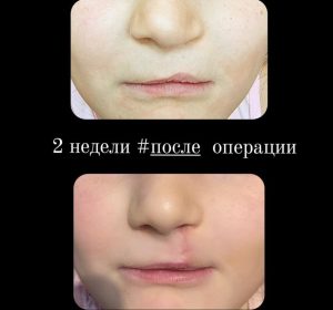 Коррекционная хейлопластика, 2 недели после опреации. В анамнезе левосторонняя расщелина верхней губы. Первичная хейлопластика в младенчестве.