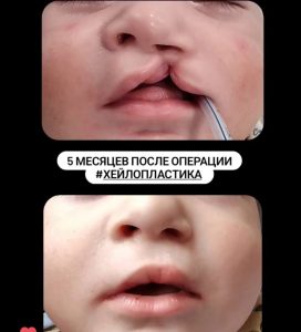 Неполная расщелина верхней губы слева. 5 месяцев после операции хейлопластика