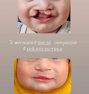 Двусторонняя расщелина верхней губы, справа полная, слева - скрытая, 5 месяца после операции хейлопластика