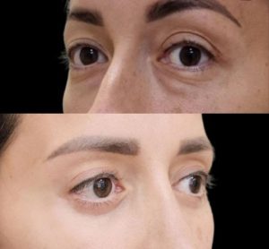 Верхняя и нижняя блефаропластика, чиклифтинг