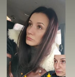Риносептопластика