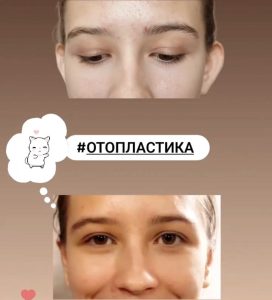 Отопластика