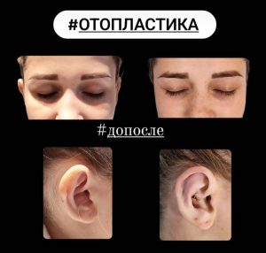 Отопластика