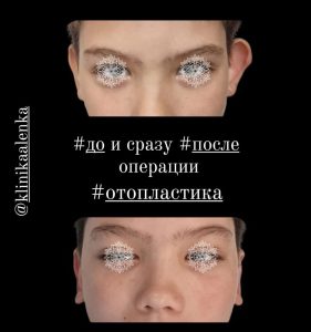 Отопластика