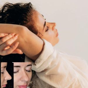 Риносептопластика. Риносептопластика. 4 месяца после операции