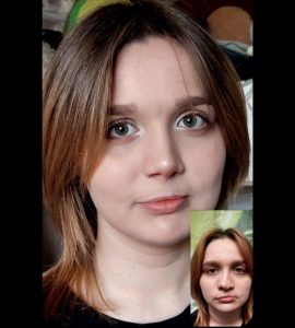 Риносептопластика, хейлопластика