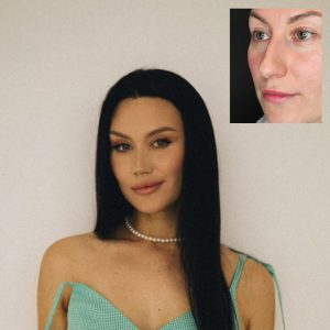 Риносептопластика, нижняя блефаропластика